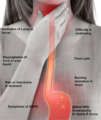 GERD – Gastro Oesophageal Reflux Disorder