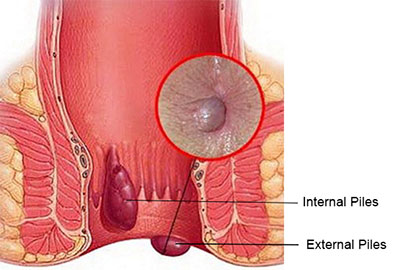 piles, Haemorrhoids and Fissure
