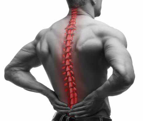 Ankylosing spondylitis